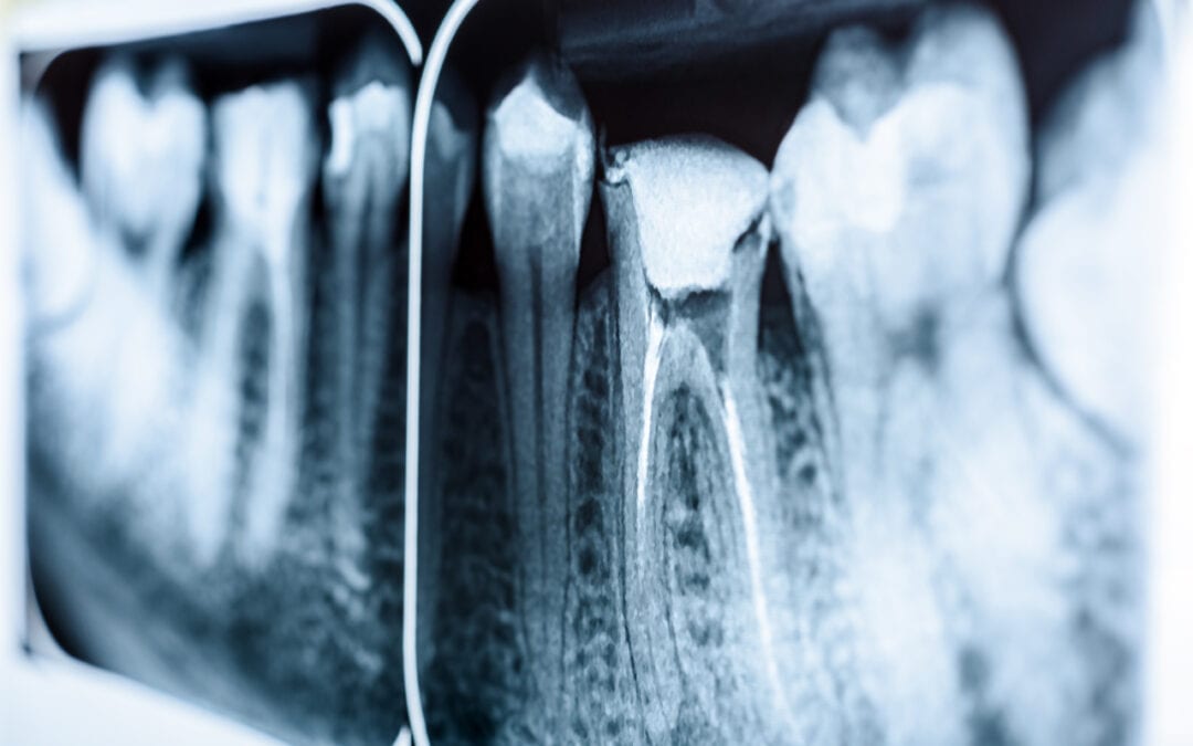 Root Canal Treatment