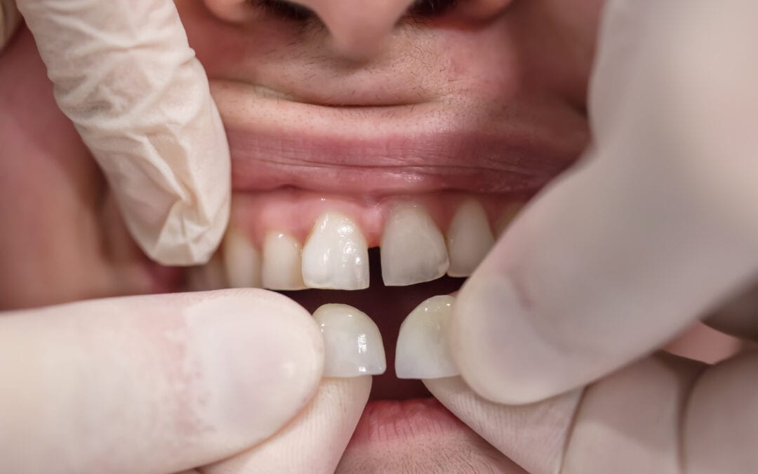 What Are Dental Veneers?