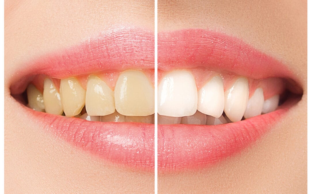Teeth Whitening: Professional vs Home Treatments