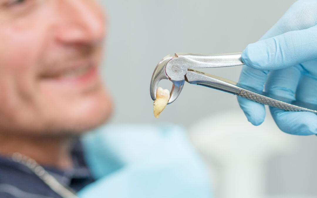 Everything You Need to Know About Tooth Extraction
